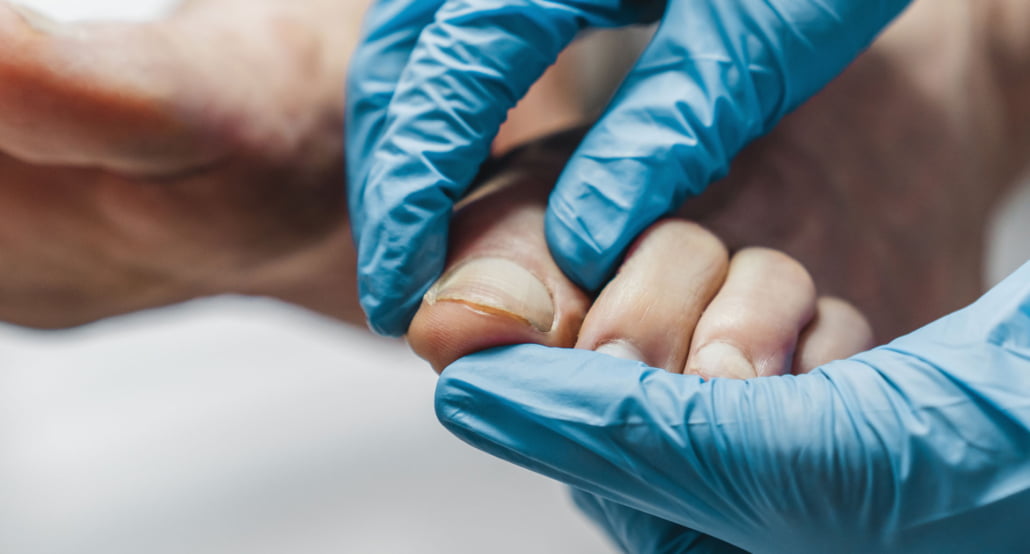 Ingrown Toenail Surgery
